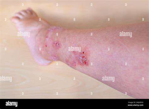 SkinIrritationsandOtherPhysicalComplaints